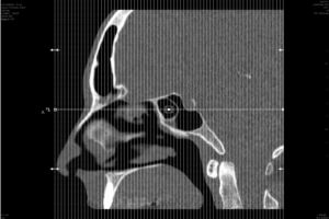 Inside my head 1 – Coronal CT Scan