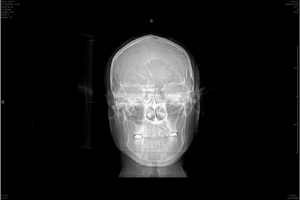 Looking into an X-Ray mirror