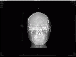 X-ray of my head - front view