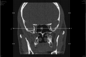 Inside My Head 3 – Sagittal CT Scan