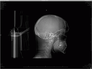 X-ray of my head - side view
